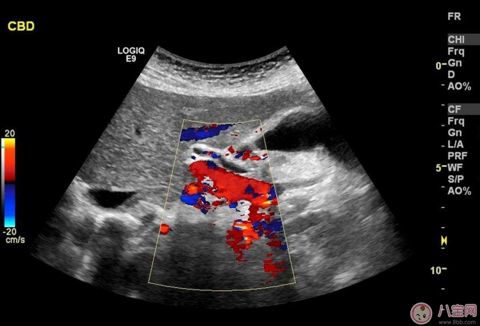 彩超|b超和彩超的区别 什么情况下使用普通B超或彩超
