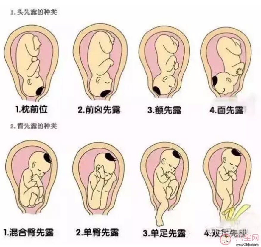 胎位|孕晚期胎位不正怎么办 孕晚期胎位图