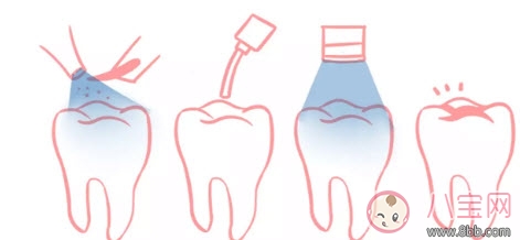 预防|宝宝蛀牙不给医生看 如何预防蛀牙减少宝宝痛苦