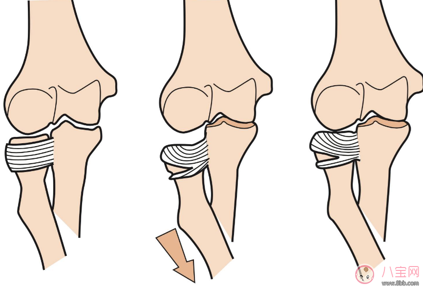 胳膊|提孩子胳膊“荡秋千”导致脱臼 孩子胳膊脱臼处理方法