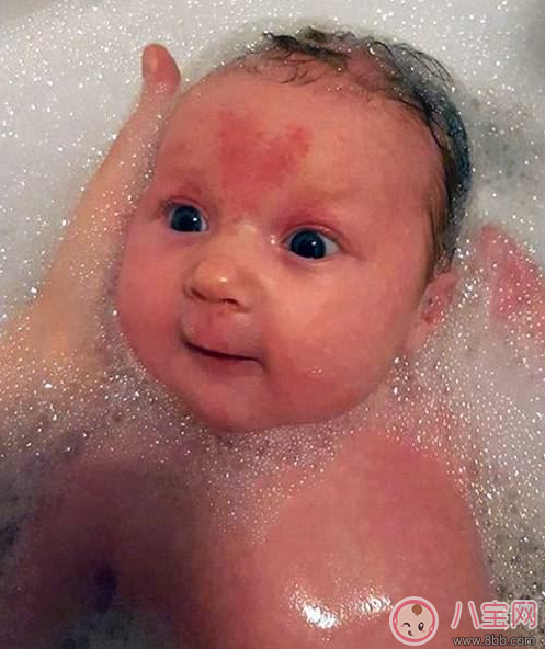 怀孕|其实在怀孕的时候注意好 宝宝也会不长胎记