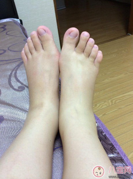 水肿|了解好怀孕水肿原因 怀孕水肿很快消