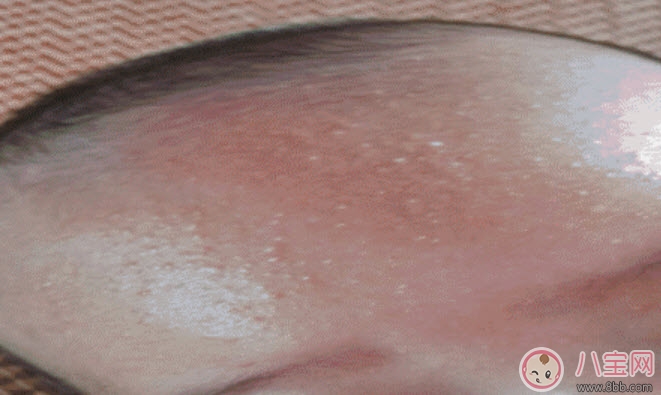 湿疹|宝宝痱子和湿疹的区别 宝宝湿疹和痱子最大的不同是什么