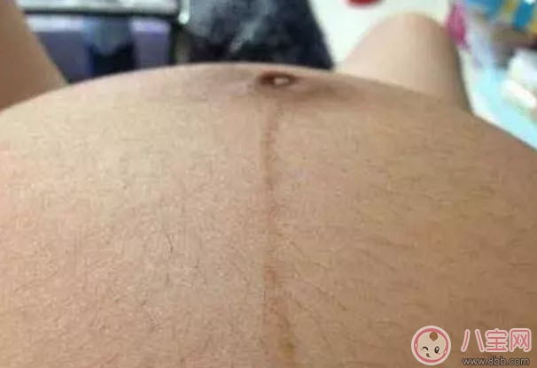 黑|孕妇怀孕后身体哪个部位容易变黑呢 孕妇变黑对宝宝会有什么影响吗