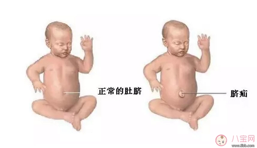 肚脐|脐疝对宝宝有什么影响 宝宝脐疝是什么原因引起的