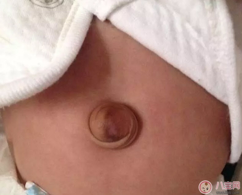 肚脐|脐疝对宝宝有什么影响 宝宝脐疝是什么原因引起的