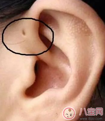 耳朵|孩子耳朵上面有小孔是什么 耳朵的小孔是富贵孔吗