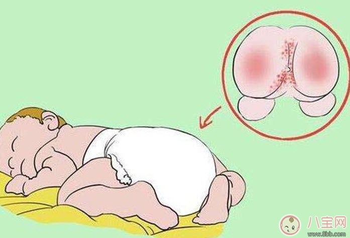 红屁股|宝宝红屁股哭闹怎么办 宝宝红屁股安抚物品