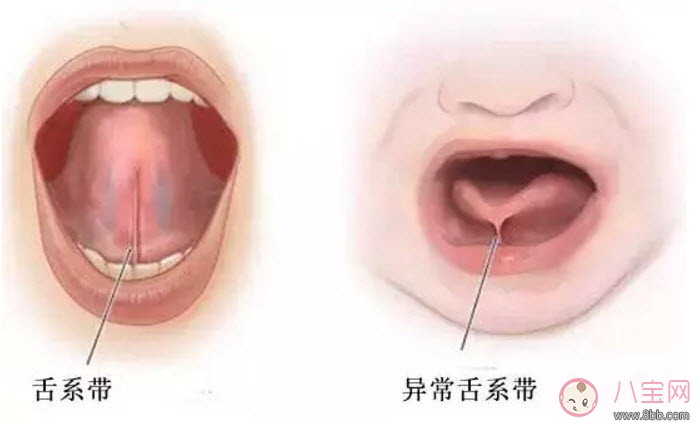 宝宝|宝宝舌系带过短怎么办 舌系带过短一定要做手术吗