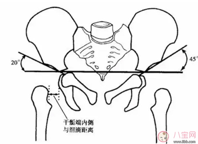 关节|宝宝臀纹不对称怎么回事 臀纹不对称一定是髋关节发育不良吗