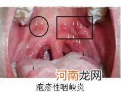 疱疹性咽峡炎的症状与治疗