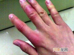 治冻疮偏方，管用吗？