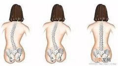 儿童脊柱侧弯的严重后果