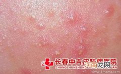 宝宝玩泥沙当心沙土性皮炎