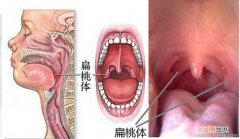 儿童10岁前最好别切扁桃体