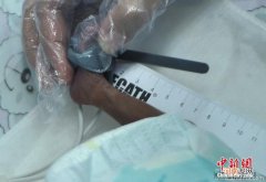 英国体重不足1斤早产儿顽强存活