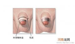 小儿包皮发炎要用热水洗