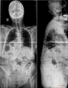 儿童脊柱侧凸该怎么治疗