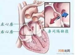先天性心脏病如何早发现