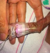 早产儿健康“早期介入”