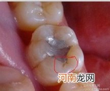 治疗龋齿试补和垫底的区别