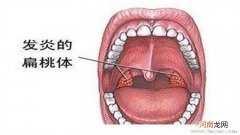 孩子五岁后再摘扁桃体