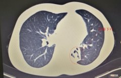 “不明原因”咳嗽可能有异物