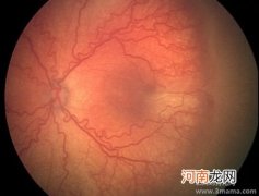 早产儿视网膜病变