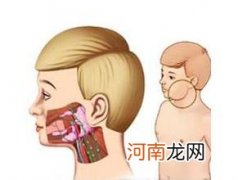 孩子得了腮腺炎怎么办？