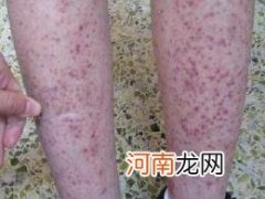 当心紫癜过后肾脏受损