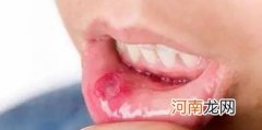 巧治宝宝的口腔溃疡