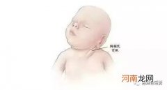 新生儿斜颈有哪些纠正方法？