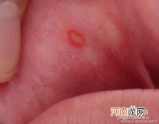 治疗小儿口腔溃疡的妙方