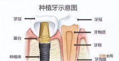 种牙有什么风险和后遗症 什么是种植牙