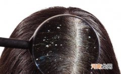 ?头皮屑多是什么原因引起的 推荐6个有效去除头皮屑的小妙招