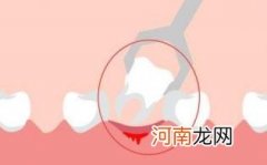 不建议下午拔牙的原因优质