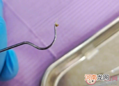 如何清洁牙缝?清洁牙缝的好处有哪些？