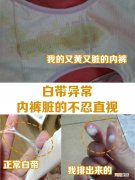 女人为什么有白带 为什么会有白色分泌物流出来