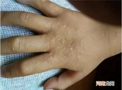 夏天孩子身上常见的几种小疙瘩 夏天儿童身上摸起来磨砂感小颗粒