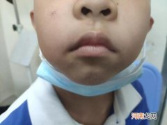 腺样体带来明显不适怎么办 腺样体几岁开始萎缩的