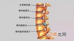 腰间盘突出症不花钱、最简单的治疗方式