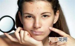 脸上长痘痘是什么原因