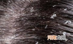 头皮屑多是什么原因导致的