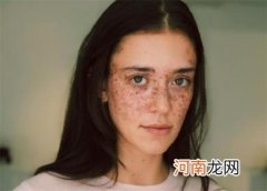 雀斑是天生的吗
