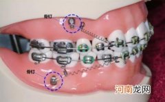 戴牙套要忌口的东西