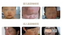 咖啡斑的较佳治疗时间是什么时候 婴儿咖啡斑的最佳治疗时间及方法